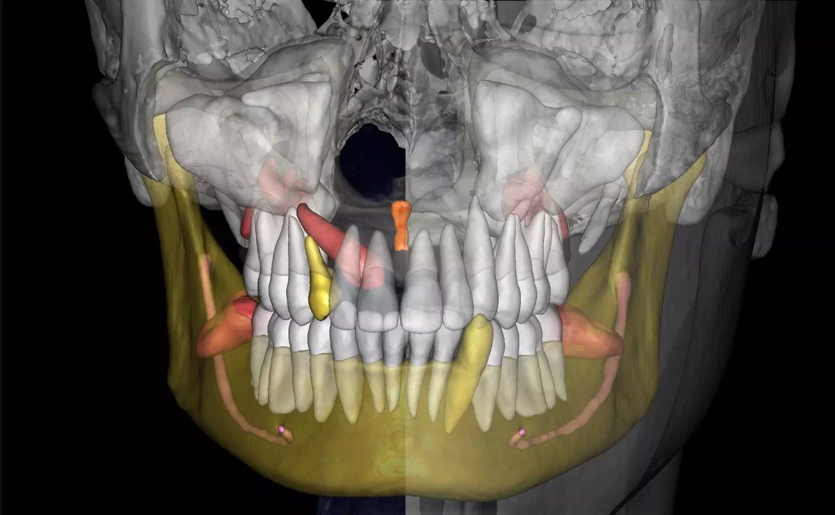 Full CBCT 3D scan showing teeth and skull structure