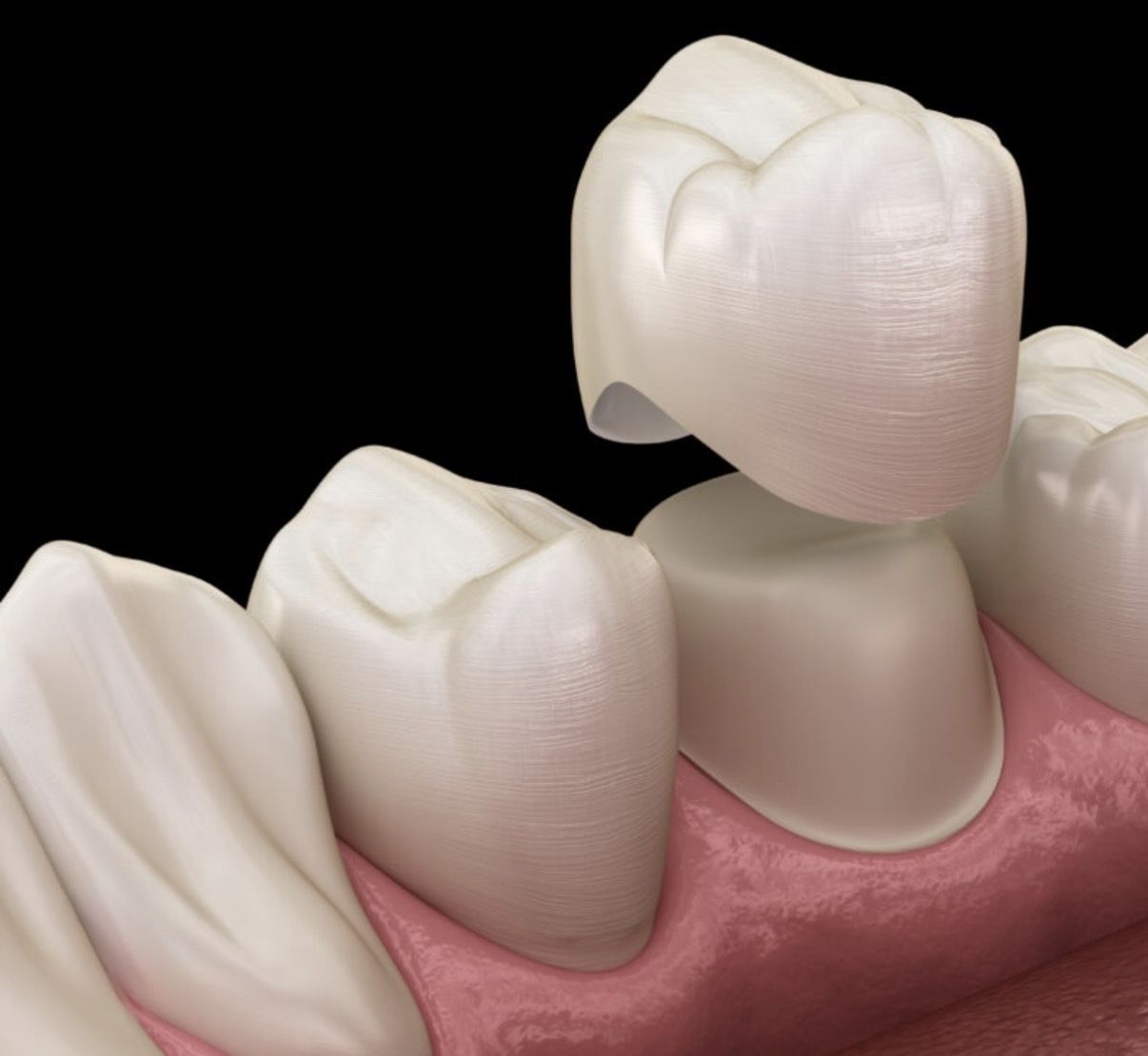 Ceramic crown fitted over prepared tooth
