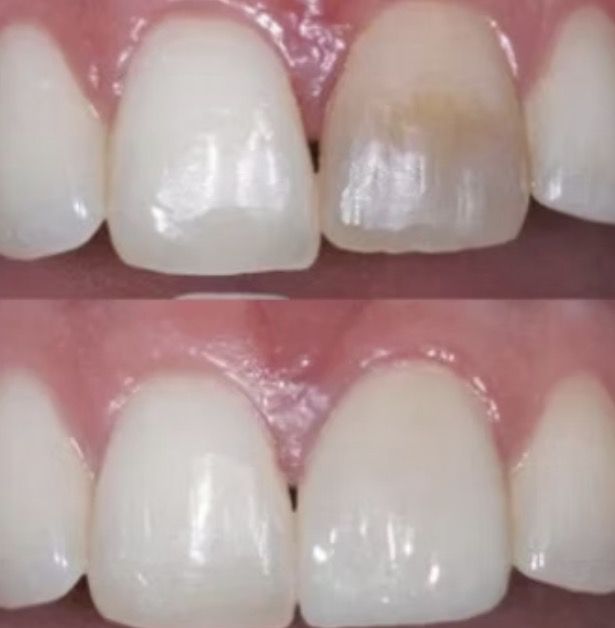 Before and after composite bonding on a front tooth