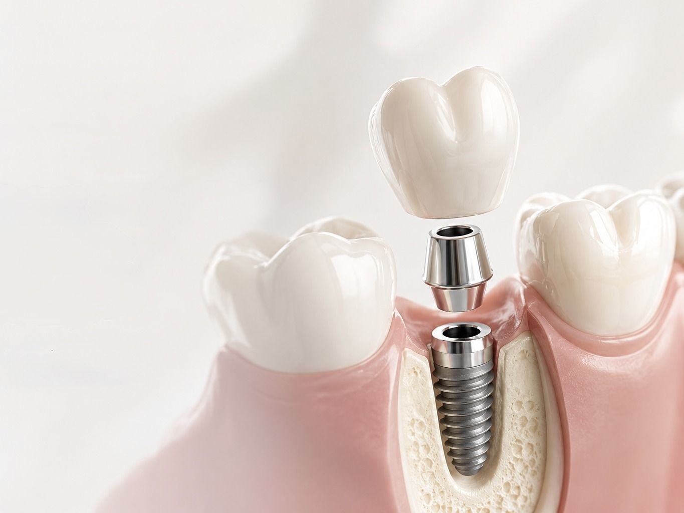 Dental implant