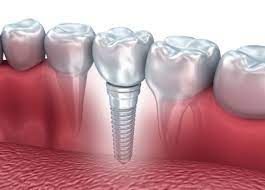 Dental implant bridge model