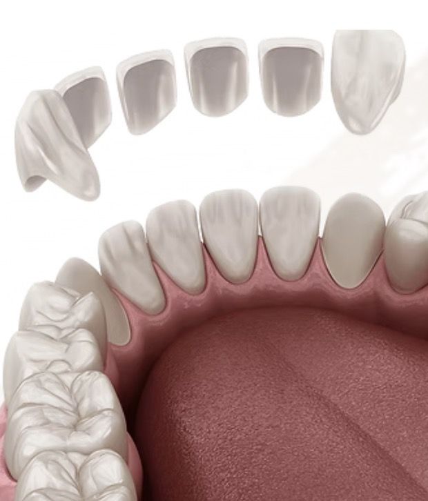 Porcelain veneers fitted over prepared teeth