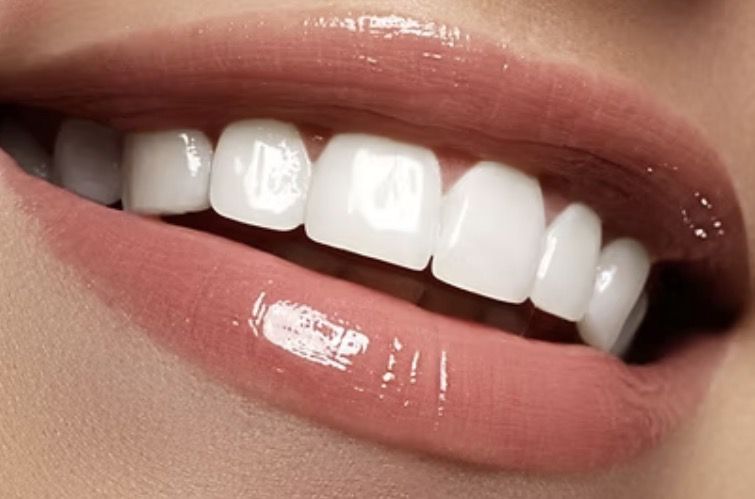 Close-up smile after porcelain veneers